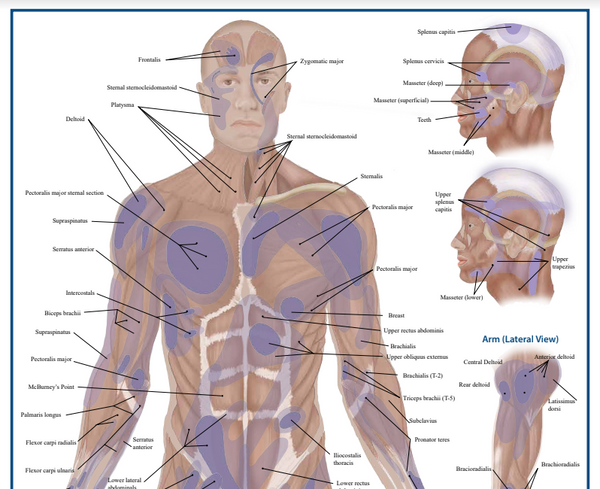 Trigger Point Anatomy Map (Poster sized) Pack of 2