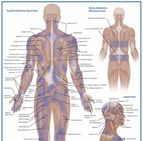 Trigger Point Anatomy Map (Poster sized) Pack of 2